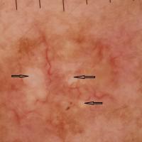 
	As previous image - dermoscopic…