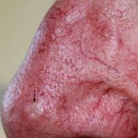 
	Trichoepithelioma - desmoplastic&nbsp;