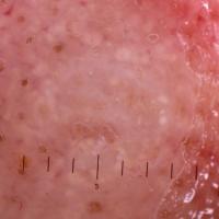 
	Same patient as previous image - dermoscopic…