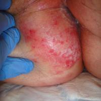 Extra-mammary Paget disease
Copied with kind…