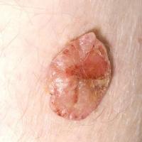 
	Malignant eccrine poroma (syn. porocarcinoma)…