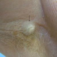 
	Spiradenoma