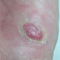 
	Eccrine poroma on the sole of the foot