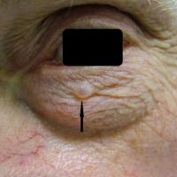 
	Eccrine hidrocystoma
