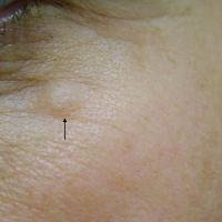 
	Eccrine hidrocystoma