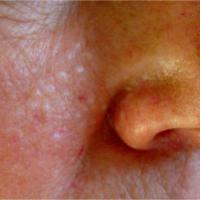 
	Fibrofolliculoma