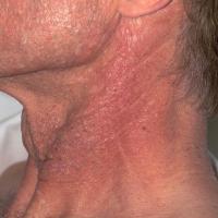 
	Fibrofolliculoma&nbsp;