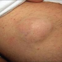 
	Mixed tumour of the skin

	Affecting the thigh…