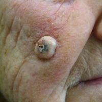 
	Inverted follicular keratosis 