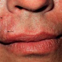 
	Microcystic adnexal carcinoma

	Arrows denote…