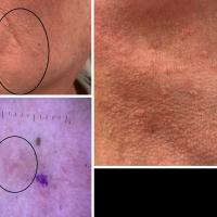 Muir-Torre syndrome
This patient had large…