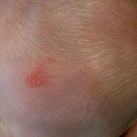 
	Naevus sebaceous