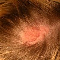 
	Naevus sebaceous