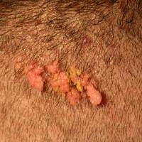 
	Naevus sebaceous