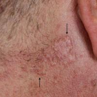 
	Naevus sebaceous
