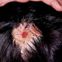 
	Naevus sebaceous (blue arrows) and BCC (purple…
