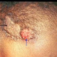 
	Naevus sebaceous (left, black arrow) and…