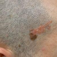 Naevus sebaceous