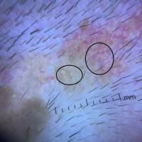 Naevus sebaceous - dermoscopic appearance of…