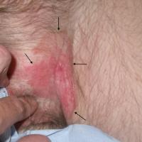 
	Extramammary Paget disease of the scrotum…