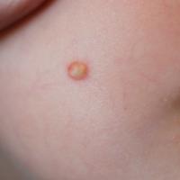 
	Pilomatricoma