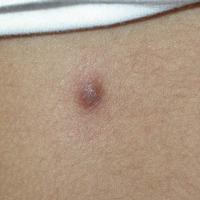 
	Pilomatricoma
