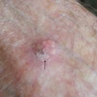 
	Pilomatricoma on the hand of an elderly…