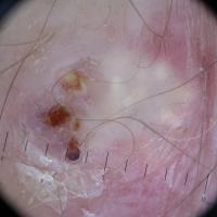 
	Dermoscopic appearance of lesion previous image