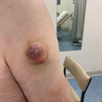 Pilomatricoma
This very large lesion, in an…