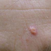 
	Sebaceous adenoma