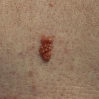 
	Syringocystadenoma papilliferum on the lower…