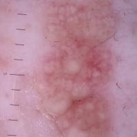 
	Dermoscopic appearance of the previous image