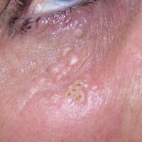 
	Syringoma 