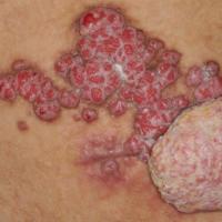 
	Syringocystadenoma papilliferum

	On the…