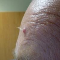 
	Trichofolliculoma