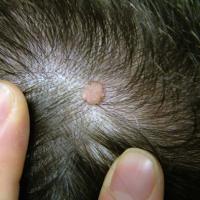 
	Trichoadenoma
