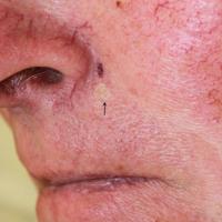 
	Trichoepithelioma

	Clinically the main…