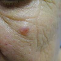 
	Trichoepithelioma - solitary 
