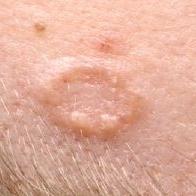 
	Trichoepithelioma - desmoplastic