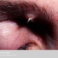 
	Trichofolliculoma