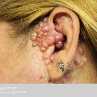 
	Trichoepithelioma - multiple
