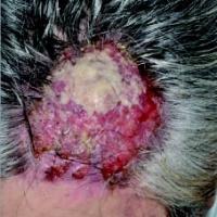 
	Apocrine carcinoma - scalp