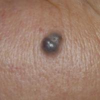 
	Apocrine hidrocystoma

	Copied with kind…