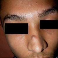 
	Mixed tumour of the skin