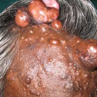 
	Cylindroma - multiple lesions 