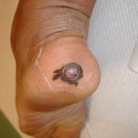 
	Eccrine poroma
	
	The black areas were old…
