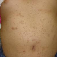 
	Eruptive vellus cysts 