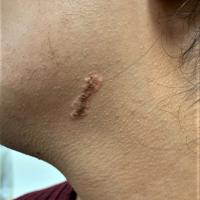 Naevus sebaceous
Copied with kind permission…