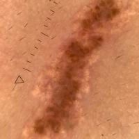 Dermoscopic appearance of previous figure
Copied…
