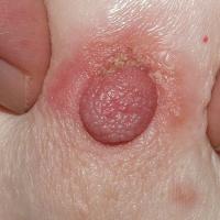 
	Paget's disease